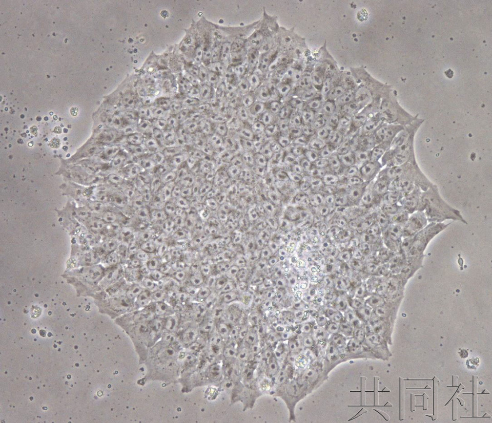 日本医疗团队展开宫颈癌iPS临床试验